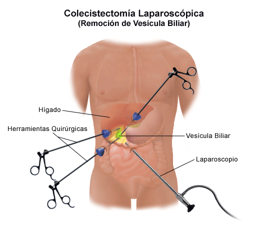 laparoscopia