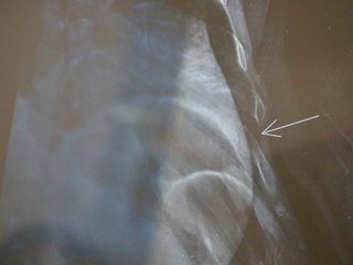 Gari cai em cal&ccedil;ada quebrada e fratura costela no centro de Domingos Martins 5