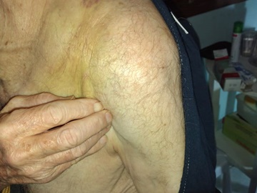 Idoso fratura três costelas e clavícula após cair de calçada 2