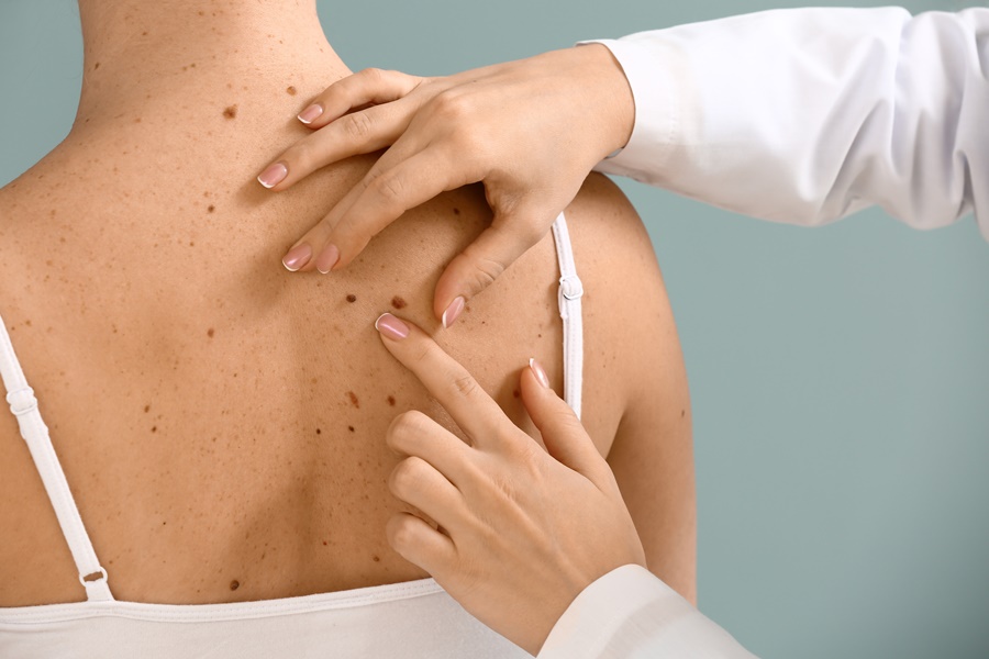 Cancer-de-pele-saiba-como-identificar-os-sinais-e-agir-preventivamente Cancer-de-pele-saiba-como-identificar-os-sinais-e-agir-preventivamente