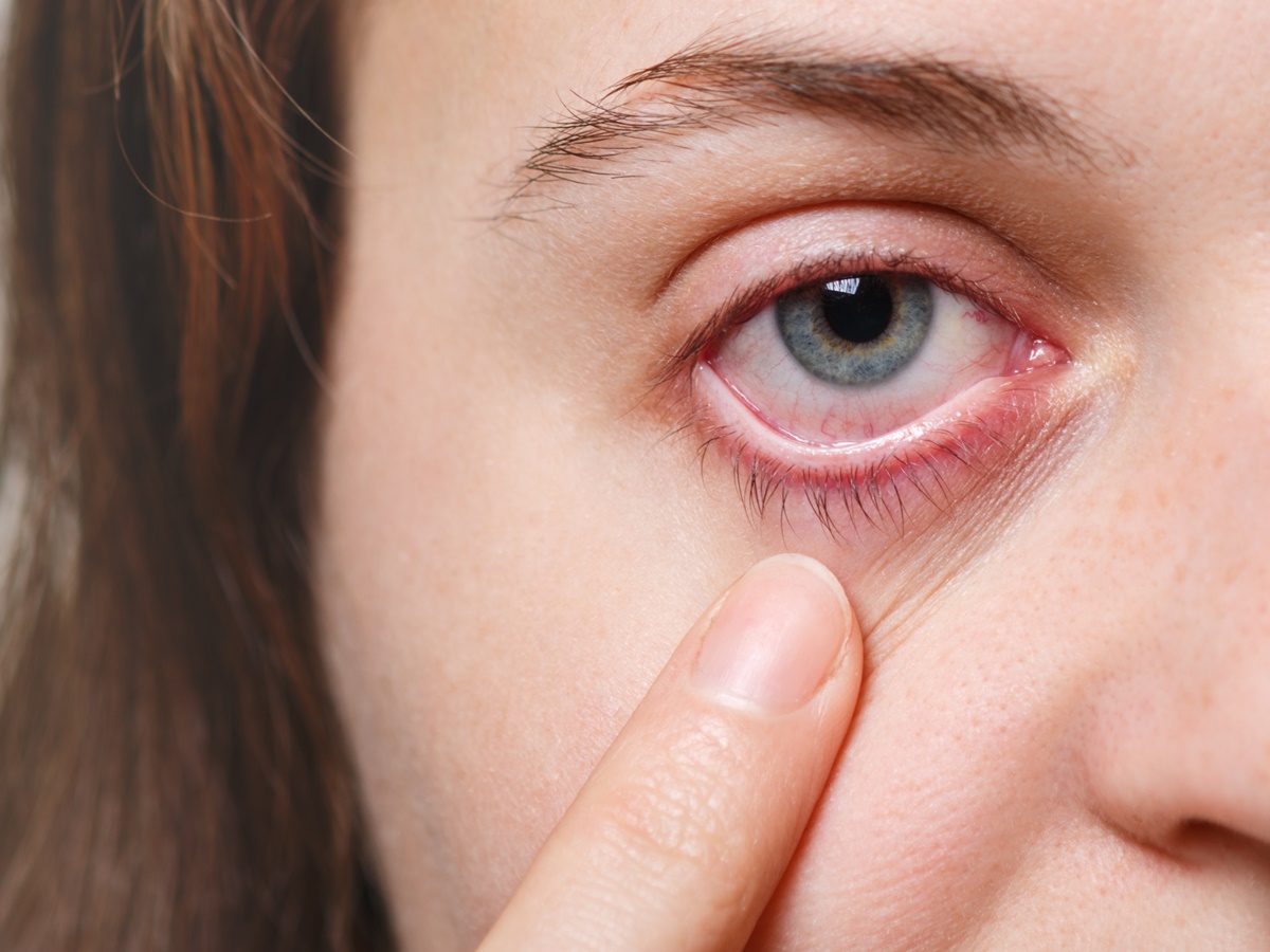 Medicine, health care and eyesight concept. Unrecognizable female shows her inflated red eye with blood capillary, has conjuctivitis. Woman with injured eye Medicine, health care and eyesight concept. Unrecognizable female shows her inflated red eye with blood capillary, has conjuctivitis. Woman with injured eye