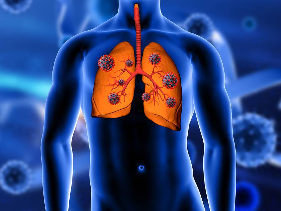 3D render of a medical background with close up of lungs being attacked by Covid 19 virus cells