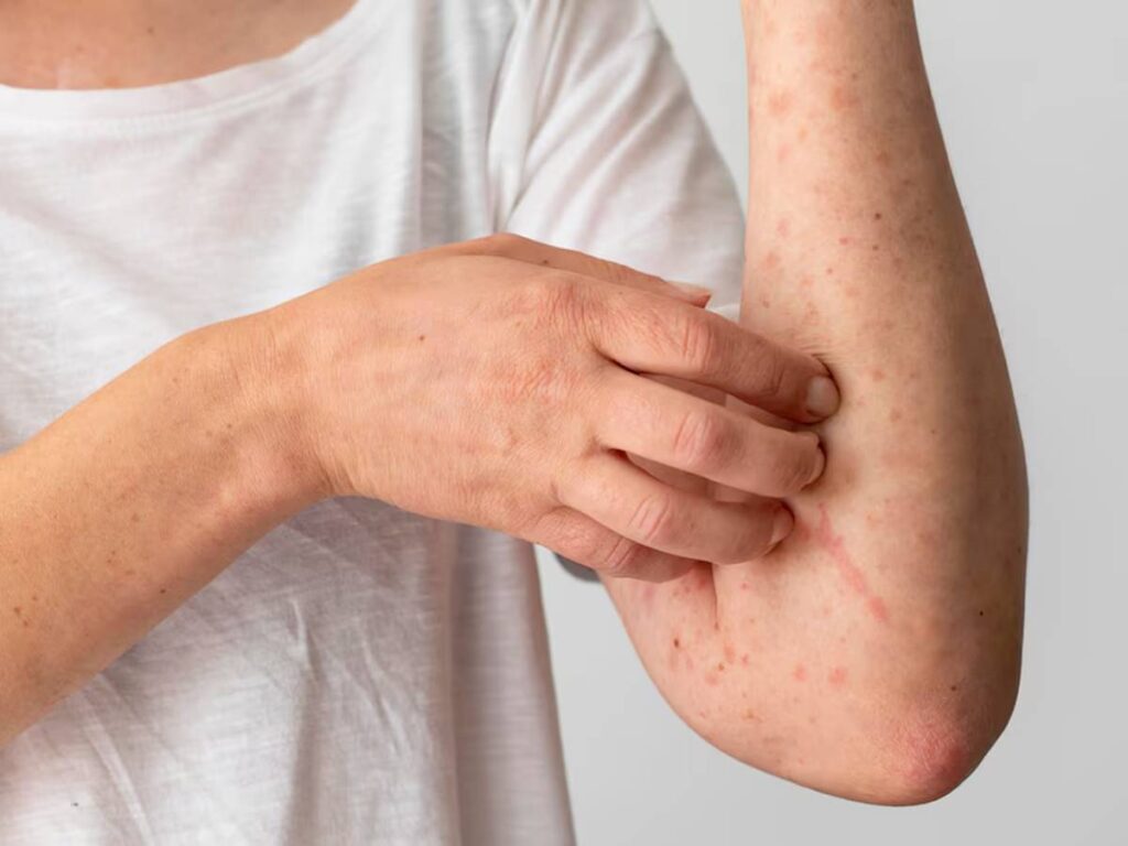 saude 23-08 - ft freepik - corpo erupções